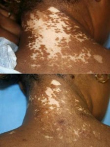vitiligo skin disorder